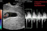 Об обязательном УЗИ органов малого таза с демонстрацией изображения и сердцебиения эмбриона / плода.